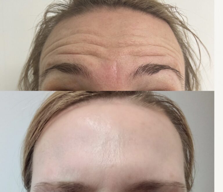 Anti  Wrinkle treatments